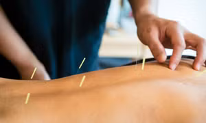 Nghiên cứu Mỹ khẳng định châm cứu hiệu quả với chứng đau lưng mạn tính