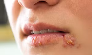 Nghiên cứu về nguồn gốc căn bệnh viêm da phổ biến do nhiễm virus herpes