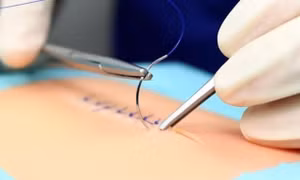 Đột phá phẫu thuật an toàn nhờ nút thắt 'lập trình sẵn'