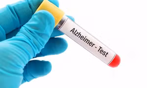 Bộ xét nghiệm máu mới giúp phát hiện sớm bệnh Alzheimer