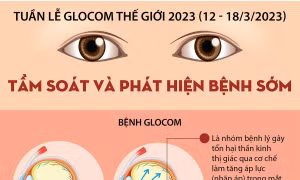 Tuần lễ Glocom Thế giới 2023 (12 - 18/3): Tầm soát và phát hiện bệnh sớm