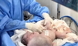 Tách thành công khối bướu nặng hơn 1kg cho cháu bé sơ sinh 3 ngày tuổi