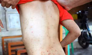 Xử lý ổ côn trùng bọ chét ký sinh trên vật nuôi lây sang người