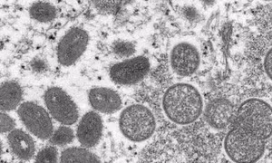 Mỹ mua hàng triệu liều vaccine phòng virus gây bệnh đậu mùa khỉ