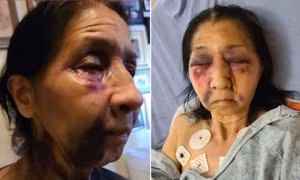Cụ bà Mexico bị đánh thâm tím mặt trên xe buýt Mỹ vì ‘trông giống người châu Á’