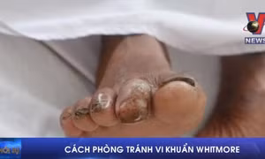 Cách phòng tránh vi khuẩn Whitmore