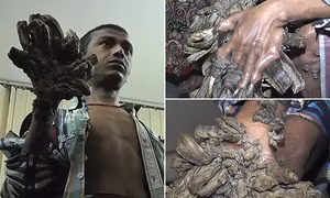 ‘Người cây’ Bangladesh cầu xin cắt cụt tay 'mọc cành' vì quá đau đớn