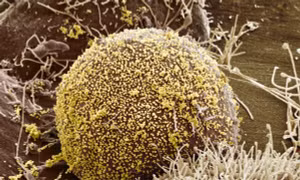 Người phụ nữ đầu tiên trên thế giới khỏi HIV nhờ liệu pháp cấy tế bào gốc