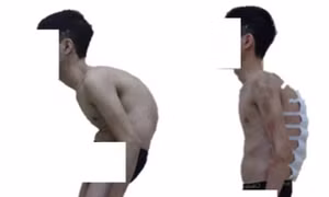 Nắn chỉnh biến dạng cột sống thành công cho bệnh nhân 'siêu gù'