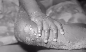 Châu Phi cần được hỗ trợ bộ xét nghiệm và vaccine phòng bệnh đậu mùa khỉ