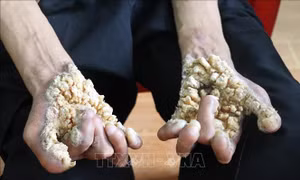 Thăm hỏi, tặng quà bệnh nhân 'người cây' tại Ninh Bình
