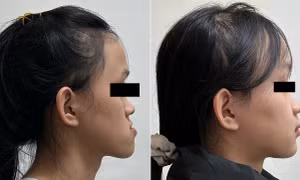 Điều trị móm (khớp cắn ngược) do xương hàm