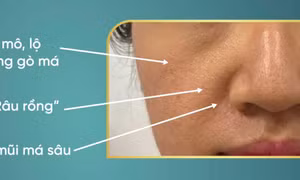 Rãnh mũi má và 'râu rồng' ở tuổi trung niên: Phương pháp thẩm mỹ nào an toàn và hiệu quả?