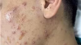 Ngành Y tế Bến Tre khuyến cáo tiếp tục xuất hiện các ca bệnh thủy đậu