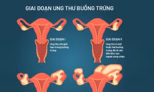 Tác động nghiêm trọng từ một trong những bệnh ung thư có tỷ lệ sống sót rất thấp