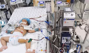 Suy hô hấp nguy kịch, một bé gái được cứu sống nhờ kỹ thuật ECMO