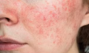 Phát hiện gene gây bệnh lupus ban đỏ