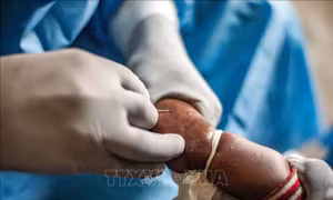 Tiếp tục đánh giá, theo dõi sát tình hình dịch bệnh đậu mùa khỉ