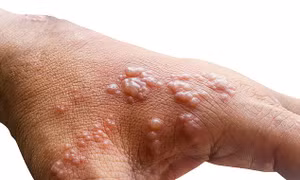 6 người Israel bị zona nghi do tiêm vaccine COVID-19 của Pfizer