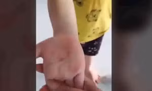 Làm rõ thông tin giáo viên mầm non dùng vật nhọn đâm vào tay bé 5 tuổi