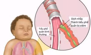 Trời chuyển lạnh, làm gì để trẻ không bị ho, mũi