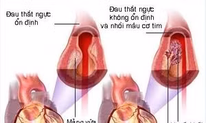 Nguy cơ nhồi máu cơ tim từ những cơn đau thắt ngực