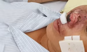 Cần nhìn nhận đúng, phát hiện nhanh bệnh Whitmore