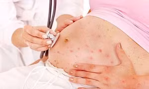 Phụ nữ mang thai mắc sởi dễ biến chứng nguy hiểm