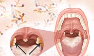 Bệnh nhân mắc bạch hầu được điều trị kịp thời, đã ổn định