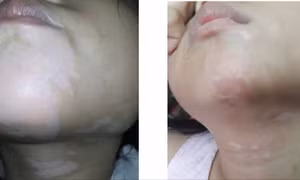 Nhận thức đúng về bệnh bạch biến để điều trị hiệu quả