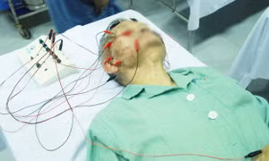 Cảnh giác tránh bị liệt mặt, méo miệng khi trời lạnh 