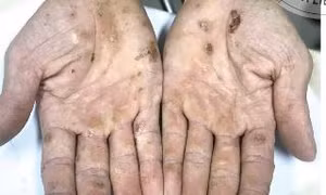 Nhiều người nhiễm độc thạch tín mà không biết