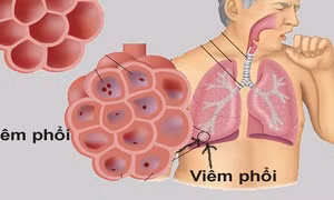 Tăng cường kiểm dịch y tế tại các cửa khẩu
