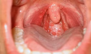 Trời lạnh, dễ tái phát viêm họng hạt, người bệnh cần kiêng gì?