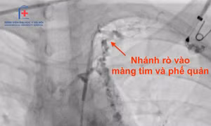 Đau tức ngực, bệnh nhân đi khám phát hiện bị viêm phế quản 'nhựa' thể hiếm gặp