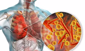 Người bị sốt, ho không rõ nguyên nhân tại Nga liên quan đến nhiễm vi khuẩn Mycoplasma