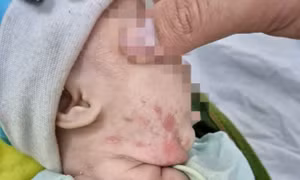 Bé gái 2 tháng tuổi bị tổn thương toàn thân vì lây bệnh giang mai từ mẹ