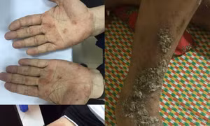 Ngứa do nhiễm ký sinh trùng từ thú cưng, nhiều người lầm tưởng là bệnh da liễu