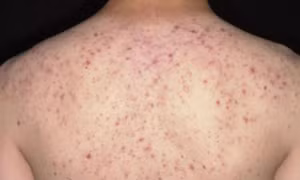 Đi chữa mụn trứng cá ở lưng, người phụ nữ suýt mất mạng
