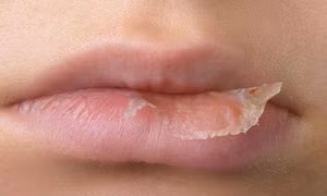 Cách giúp môi không bị nẻ khi trời khô hanh