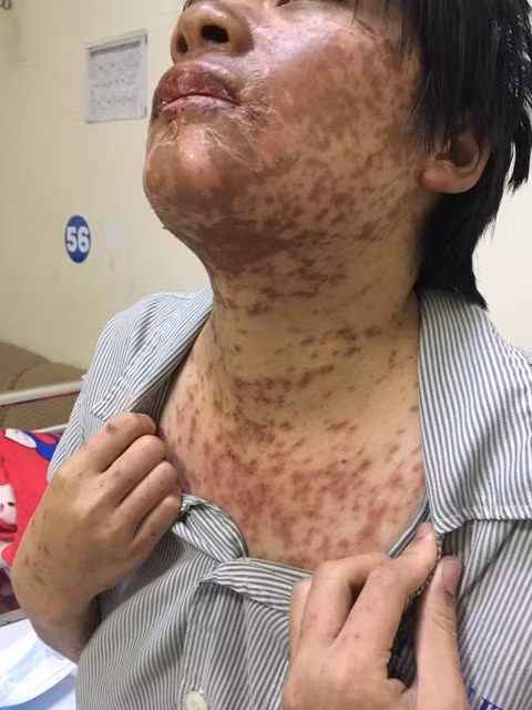Bị biến dạng mặt, người mưng mủ vì tự ý mua thuốc uống ảnh 1