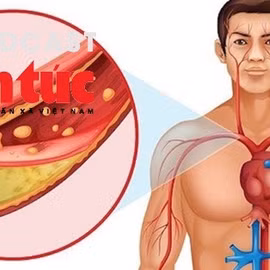 "Bác sĩ ơi' - Kiểm soát Cholesterol máu thế nào là đúng?