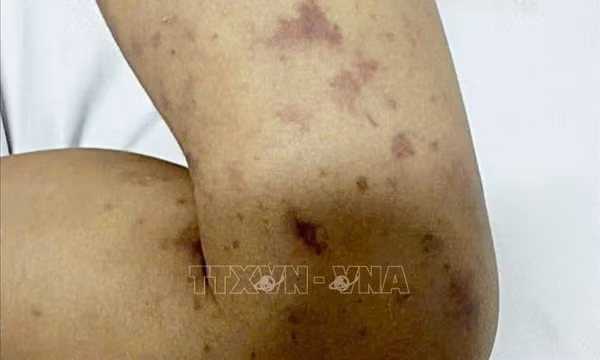 Cà Mau ghi nhận 2 ca tử vong liên tiếp do vi khuẩn não mô cầu
