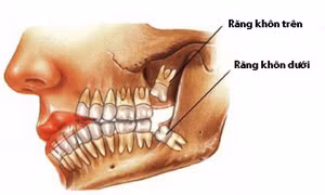Nhổ răng khôn có thể gặp những nguy hiểm gì?