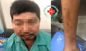 Sưng mặt, teo tay chân vì dùng thuốc đông y không rõ thành phần 