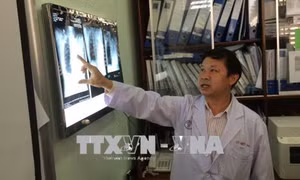 Bệnh nhân 4 lần ngừng thở, tụt huyết áp khi gắp hạt na ra khỏi phổi 