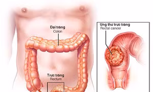  Cơ hội sớm phát hiện ung thư đường tiêu hóa tại Medlatec
