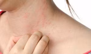 Cách phòng tránh bị mụn, viêm da khi trời nồm, ẩm