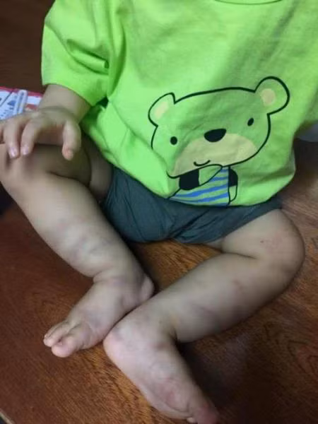 Bé trai bị bạo hành đến chấn thương sọ não đã được xuất viện ảnh 1