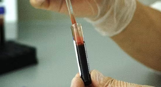 Phương pháp thử máu mới phát hiện ung thư trước khi có triệu chứng ảnh 1